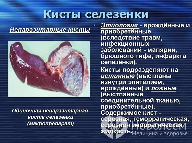 Кисты селезенки бывают нескольких видов, подход к лечению зависит от вида