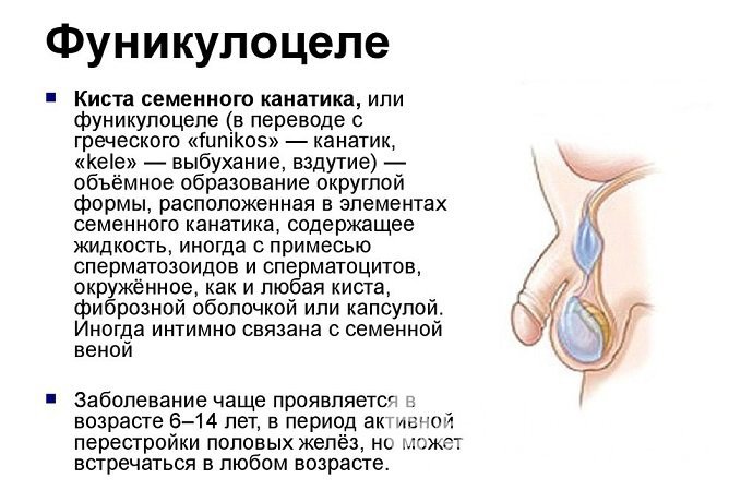 Киста семенного канатика, или фуникулоцеле, в большинстве случаев лечения не требует