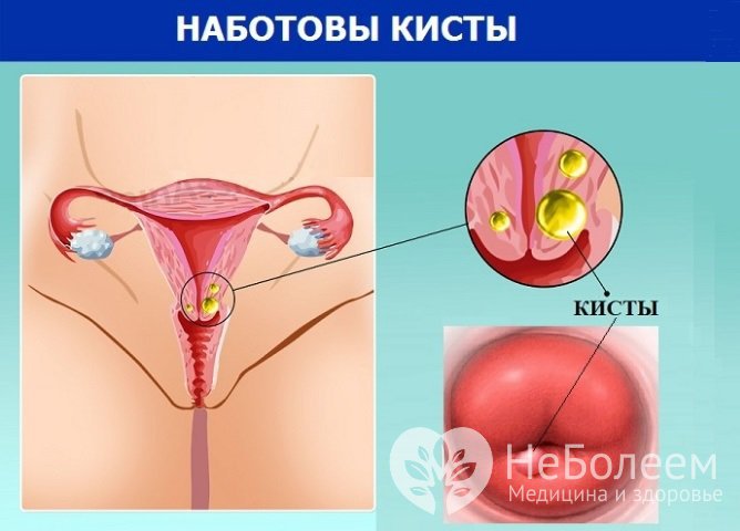 Киста шейки матки, или наботова киста – полое образование, заполненное слизью