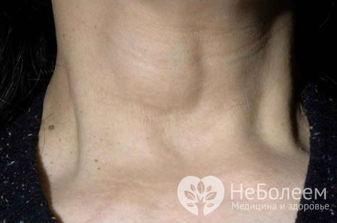 Кисты щитовидной железы чаще развиваются у женщин старше 40 лет