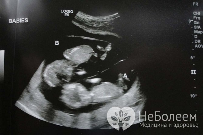 Скрининговое УЗИ во втором триместре беременности позволяет выявить кисту сосудистого сплетения у плода