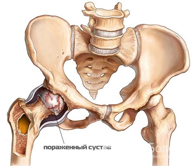 Коксартроз тазобедренного сустава 1 степени: причины, симптомы, лечение, профилактика