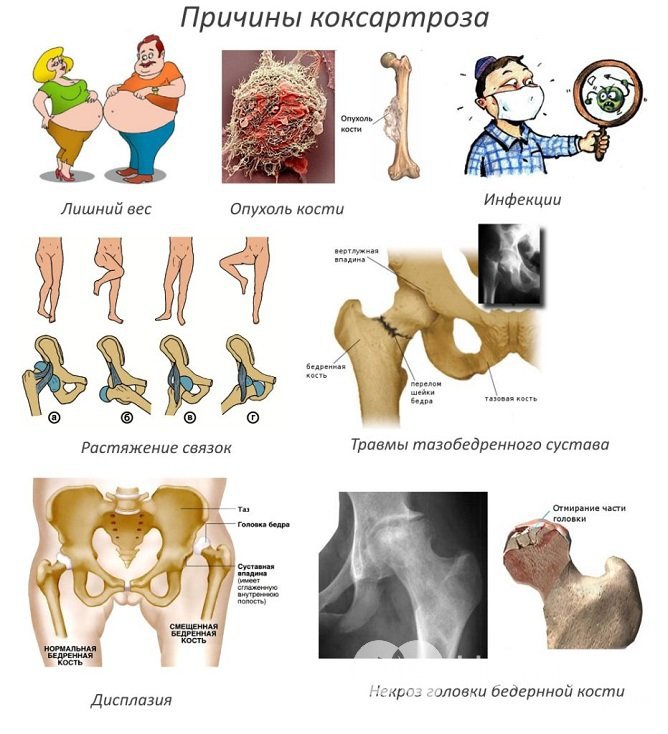 К развитию коксартроза могут приводить различные причины