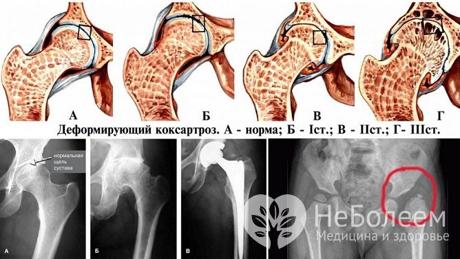 Коксартроз развивается постепенно и приводит к снижению подвижности нижней конечности