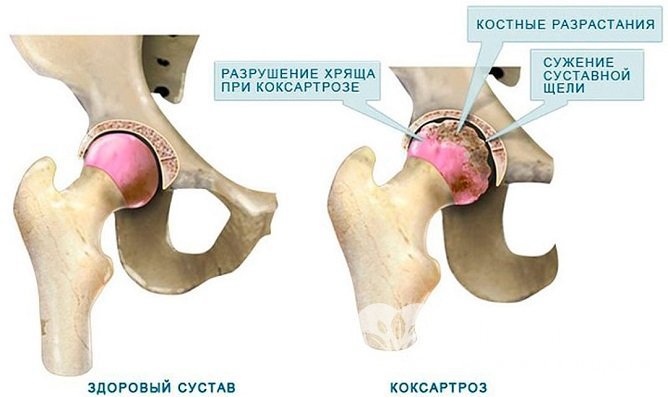 При остеоартрозе хрящевая ткань теряет эластичность и появляются костные разрастания