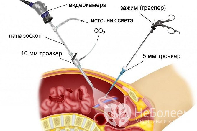 Лапароскопическое вмешательство обеспечивает бережное, атравматичное удаление овариальной кисты