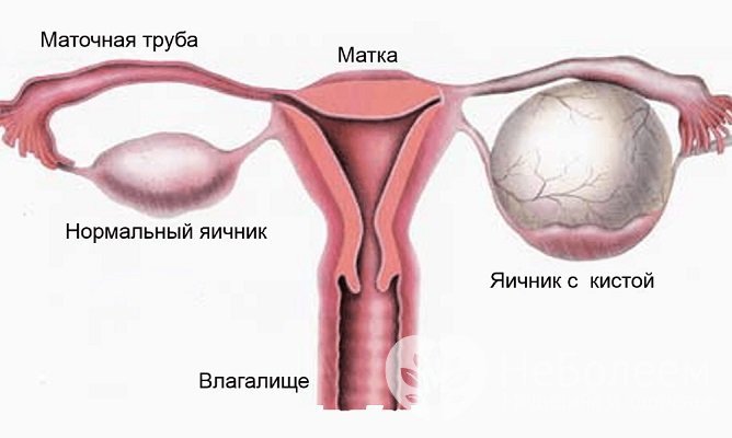 Овариальная киста является доброкачественным новообразованием