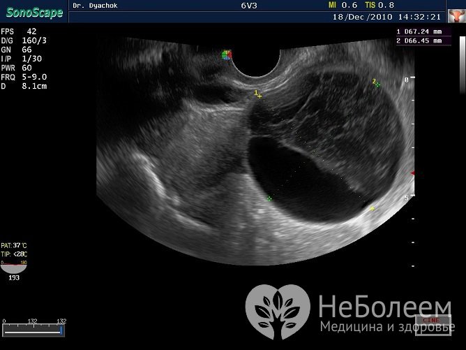 Киста желтого тела диагностируется по результатам УЗИ