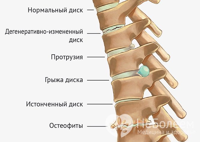 Межпозвонковая грыжа формируется из-за дегенеративных процессов в диске, разделяющем позвонки