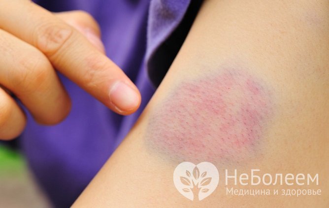 Народные средства от синяков: эффективные методы лечения в домашних условиях