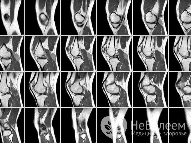 Для уточнения диагноза и определения степени деформации тканей назначается магнитно-резонансная томография