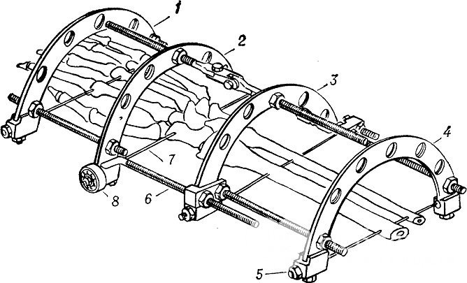 В тяжелых случаях применяются шарнирно-дистракционные аппараты Волкова – Оганесяна