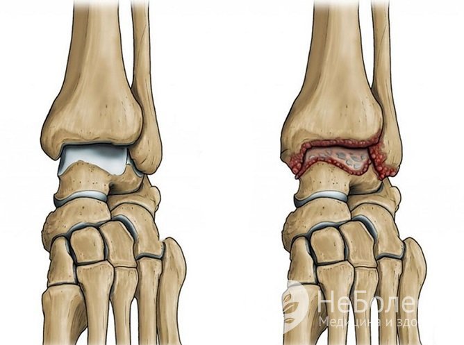 Остеоартроз голеностопного сустава связан с дегенеративными изменениями хрящевой ткани