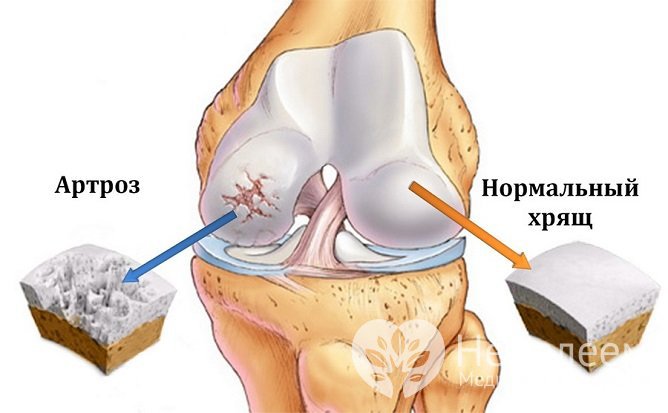 Остеоартроз коленного сустава 1 степени: причины, симптомы, лечение