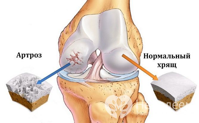 При гонартрозе происходит постепенное разрушение суставного хряща
