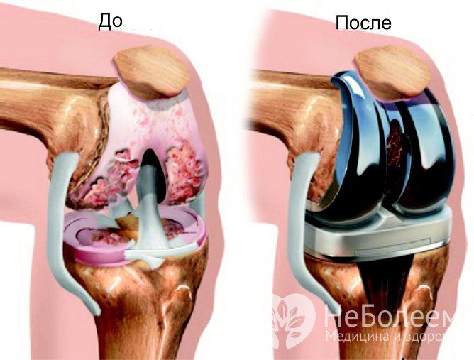 При неэффективности медикаментозной терапии проводится эндопротезирование коленного сустава