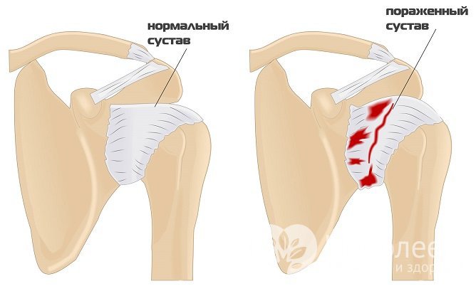 При остеоартрозе в процесс разрушения суставного хряща постепенно вовлекаются все ткани сочленения, костей и мышц