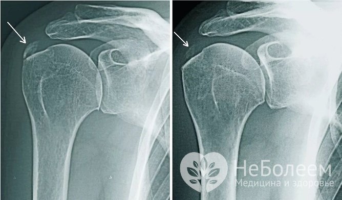 Подтвердить диагноз можно с помощью рентгенографии