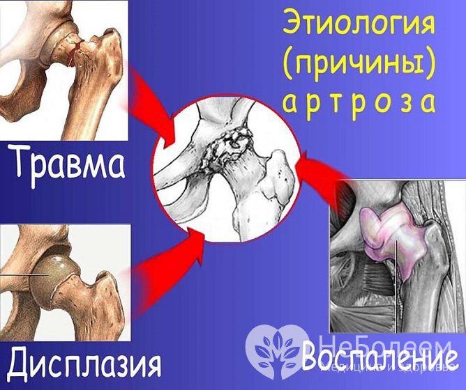 Развитие патологии может быть связано с травмой, дисплазией или воспалением