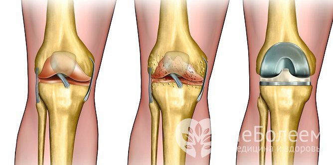 При тяжелом течении патологии проводится эндопротезирование
