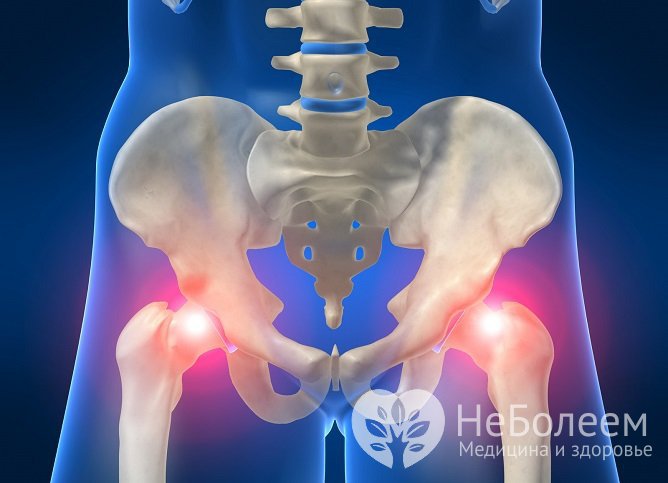 Коксартроз относится к числу распространенных поражений суставов