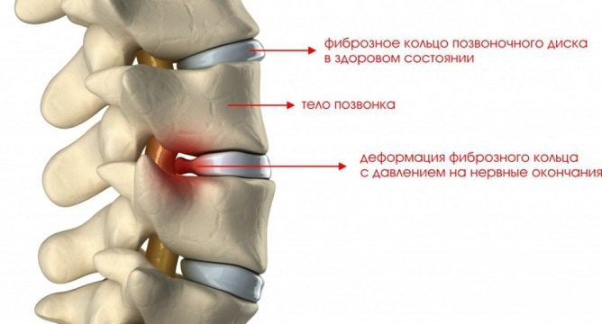 Остеохондроз 2 степени
