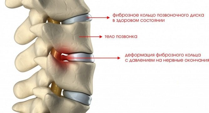 На второй стадии остеохондроза межпозвонковый диск деформируется, но ярко выраженные симптомы еще отсутствуют