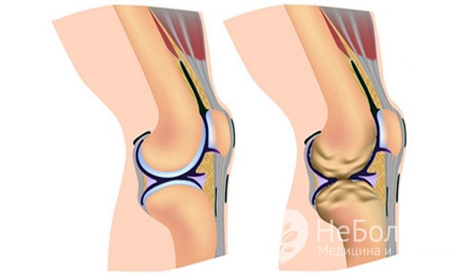 Гонартроз - один из часто встречающихся видов поражений суставов, что связано с повышенной нагрузкой на колени