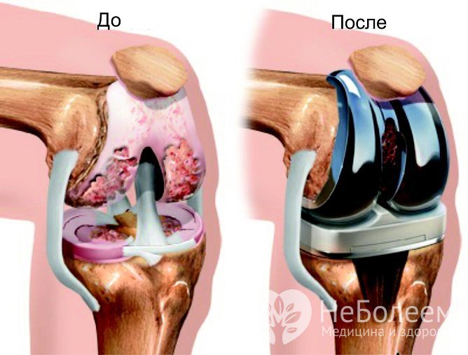 Замена коленного сустава искусственным показана в случае неспособности его выполнять свою функцию