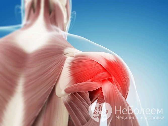 Остеохондроз плечевого сустава может привести к значительному ограничению движений в нем
