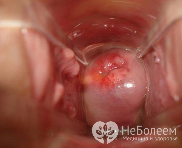 Папилломы на шейке матки обладают риском перерождения в злокачественную опухоль