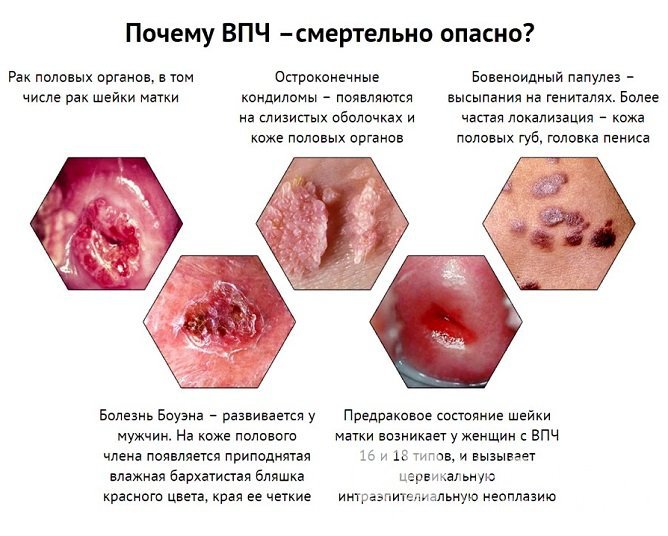 Вагинальные папилломы представляют собой опасность в отношении возможного перерождения в рак