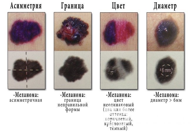 Меланому отличить от невуса по внешним признакам сложно, требуется осмотр врача