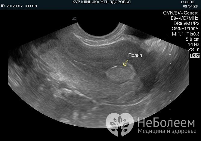 УЗИ позволяет определить наличие эндометриальных полипов и место их прикрепления