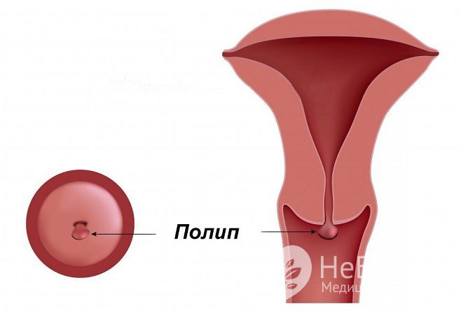 Полип шейки матки возникает по разным причинам и требует своевременной диагностики и лечения