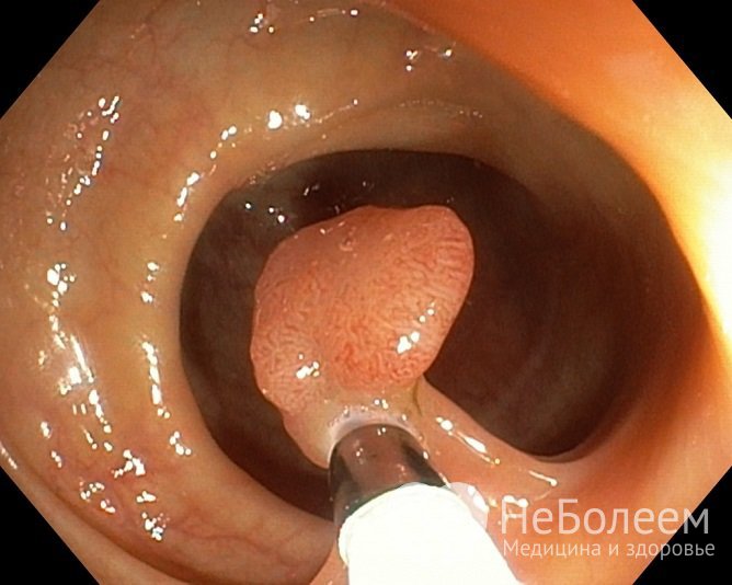 Наиболее эффективным методом терапии является полипэктомия