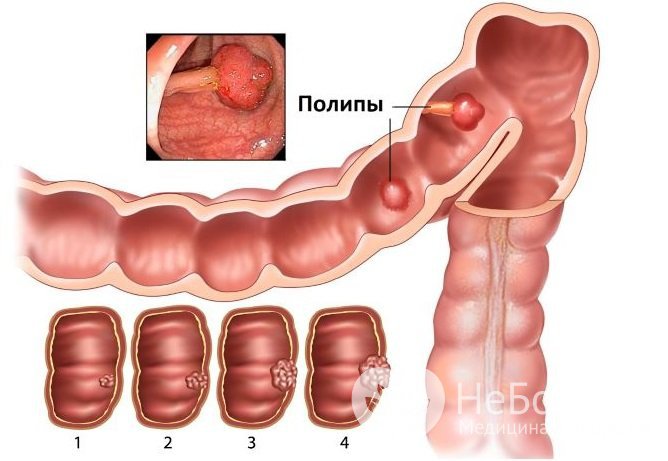 Полипы в кишечнике: симптомы, лечение, прогноз и профилактика