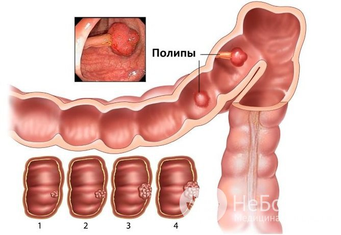 Полипы могут возникать в любом отделе кишечника