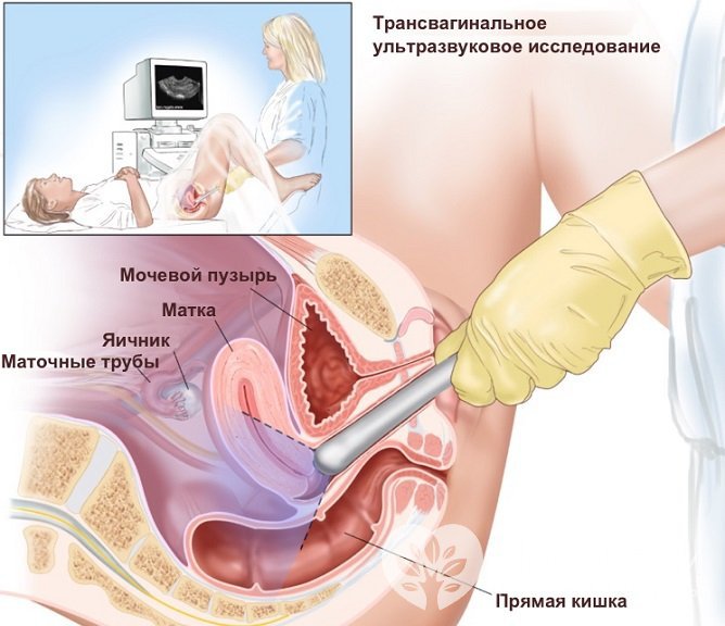 Для выявления новообразований обычно назначается трансвагинальное УЗИ