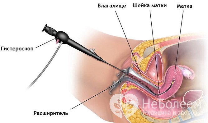 Один из безопасных методов удаления полипов – гистероскопия