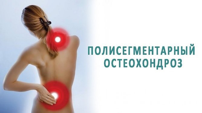 Полисегментарный остеохондроз позвоночника