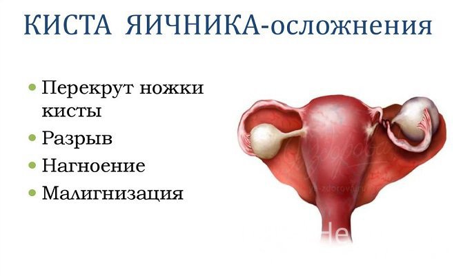 Ретенционные кисты яичника обычно нуждаются в хирургическом удалении только в случае развития осложнений