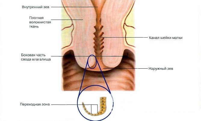 Ретенционные кисты шейки матки