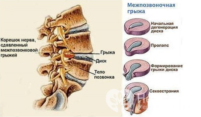 Секвестрированная грыжа позвоночника