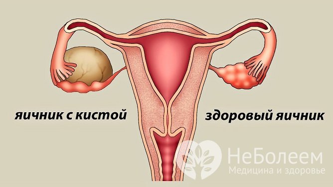 Серозные кисты яичника встречаются у женщин репродуктивного возраста