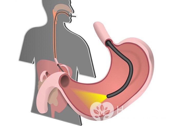 Эзофагогастроскопия позволяет достоверно установить диагноз