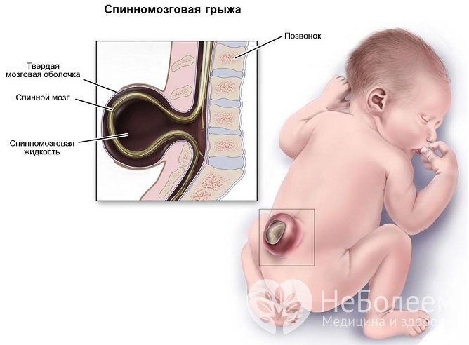 Спинномозговая грыжа – врожденный порок развития