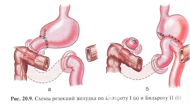 Чаще всего проводится резекция по Бильборту I или Бильборту II