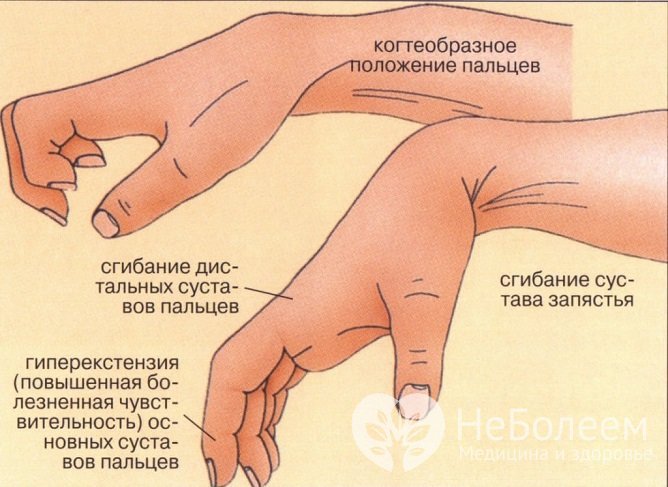 При серьезных повреждениях запястья возможно развитие дистрофических изменений в костях