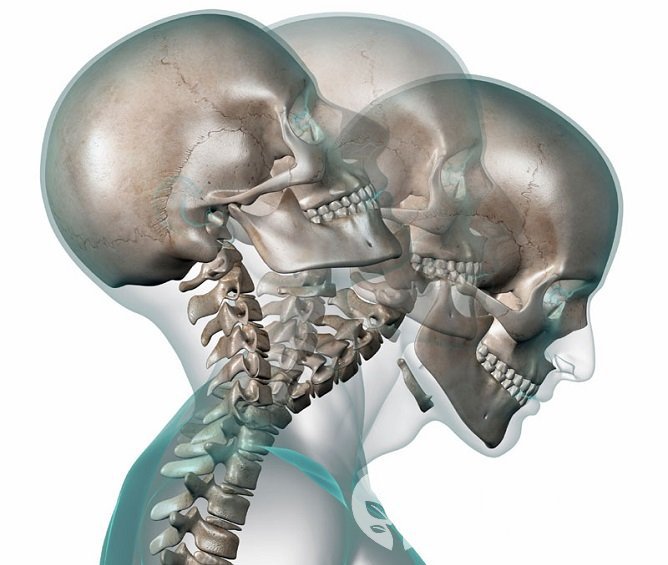 Повреждения шейного отдела часто связаны с хлыстовой травмой